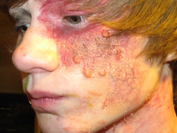 Warts on lip