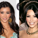 Celebrity Botox: Before and Afters