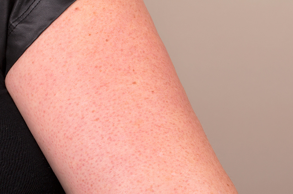 How To Treat Keratosis Pilaris Those Scaly Red Bumps On Your Upper Arms Beautylish 