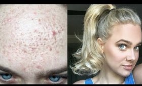 HOW I GOT RID OF ACNE IN ONE MONTH | (BLESSSS 🙏)