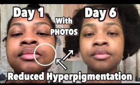 I Used Apple Cider Vinegar For 1 week To Reduce Hyper-pigmentation