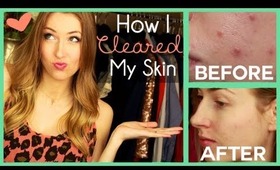 ♥ Clear Skin Tips: How I Got Rid of Acne for GOOD (& What I Did WRONG!)