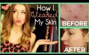 ♥ Clear Skin Tips: How I Got Rid of Acne for GOOD (& What I Did WRONG!)