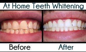 Smile Brilliant At Home Teeth Whitening!