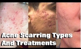 ACNE SCARRING TREATMENTS! For Mild, Moderate & Severe Acne Scars | Skin Care Tip Tuesday
