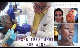 Vampire Facial + Co2 Laser for ACNE SCARS with MetroMD.Net