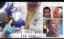 Vampire Facial + Co2 Laser for ACNE SCARS with MetroMD.Net