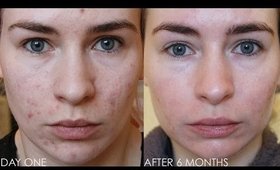 ROACCUTANE MONTH 6 - Update & Daily Skin Vlog!