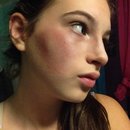Stage makeup bruising 