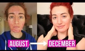 4 MONTH ACCUTANE UPDATE | How To Care For Your Skin On Accutane