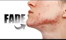 ACNE: HOW TO: PURPLE/RED MARKS SCARS AND HOW TO GET RID OF THEM!