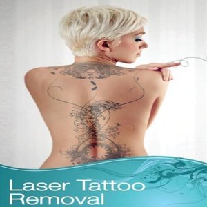 http://www.celcius.com.au/pages/tattoo-removal