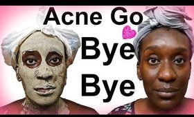 DIY Bentonite Clay SkinCare Routine | Best Face Mask For Acne and Blemishes