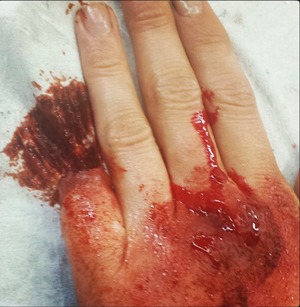 This is my college work for my casualty assignments. I created an amputated finger using derma wax and blood and also a deep wound with glass stuck in it, again using derma wax. It took time but it's worth the wait for the effects to show. It wont let me list derma wax in the products used section, but derma wax was used to create this look.