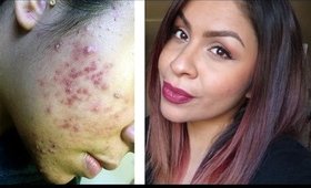 How I Used Apple Cider Vinegar To Clear My Skin & Get Rid Of Acne