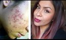 How I Used Apple Cider Vinegar To Clear My Skin & Get Rid Of Acne