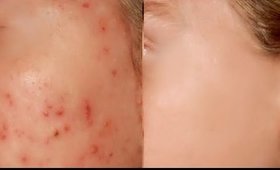 How to Remove Pimples Overnight? __ Natural Acne Treatment | SuperWowStyle