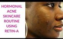 My Hormonal Acne Skincare Routine Using Retin-A