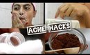 Acne - 5 Acne Hacks & How to Treat Acne Prone Skin | 5 Face Wash Tips