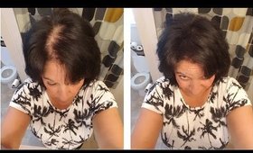 Caboki for Women with Hair Loss