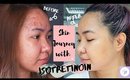 SKIN JOURNEY l ISOTRETINOIN (ACCUTANE) EXPERIENCE l BEFORE AND AFTER VIDEOS