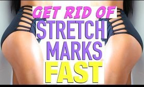 GET RID OF STRETCH MARKS!!! | 10 FAST HACKS!!! | REALLY WORKS!!!