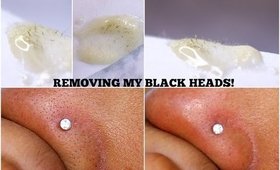 How I remove my Black heads - Update Queenii Rozenblad