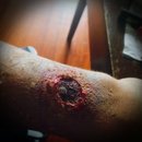 wound on the arm 1