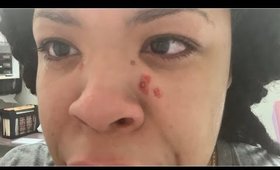 Dermatologist Vlog : Skin tag removal!