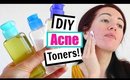 DIY Natural Toner For Acne & Oily Skin! 3 Easy Homemade Toners!