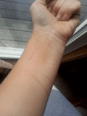 cutting wrists scars