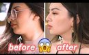 GOT RID OF MY DOUBLE CHIN✨ KYBELLA BEFORE AND AFTER EXPERIENCE / REVIEW