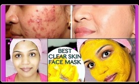 Best Acne Treatment Get Rid Of Acne Fast Naturally, How to Get Flawless skin,Treat Acne Scars