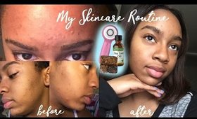 My Simple 3-Step Skincare Routine | How I Cleared My Acne