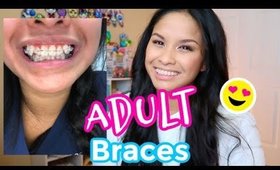 Braces 101: What to expect | Cost | High Canines | My 7 Month Progress