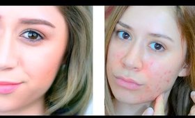 HOW TO GET RID OF ACNE SCARS | Exfoliation routine