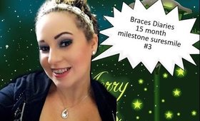 Braces Diaries Update 15 Months Milestone