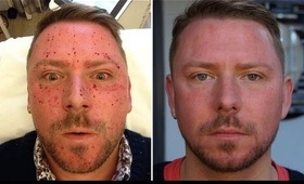 MY SKIN LASER EXPERIENCE! OUCH! BEFORE AND AFTER! WARNING REQUIRED LOL