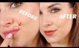 How to Cover Lip Acne | Bailey B.