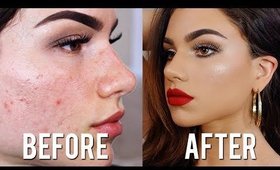 How To Cover ACNE & SCARS with Makeup! Full Coverage Foundation & Concealer Tutorial