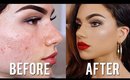 How To Cover ACNE & SCARS with Makeup! Full Coverage Foundation & Concealer Tutorial