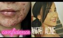 How To Be Confident With Acne/How To Be Confident Without Makeup!