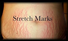 HOW TO GET RID OF STRETCH MARKS: NATURAL & AFFORDABLE REMEDY!PhillyGirl1124 on YouTube