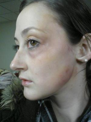 "you should see the other girl" ;) 