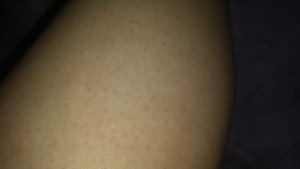 Black Dots On Legs? Help! | Beautylish