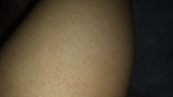 Black Dots On Legs Help Beautylish