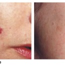 Laser Skin Treatments in Adelaide for Amazing Results