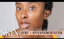 How To Get Rid of Acne Scars + Hyperpigmentation In 1 Month