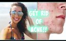 How I Cleared My Acne!