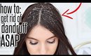 How To Get Rid Of Dandruff After ONE WASH !!